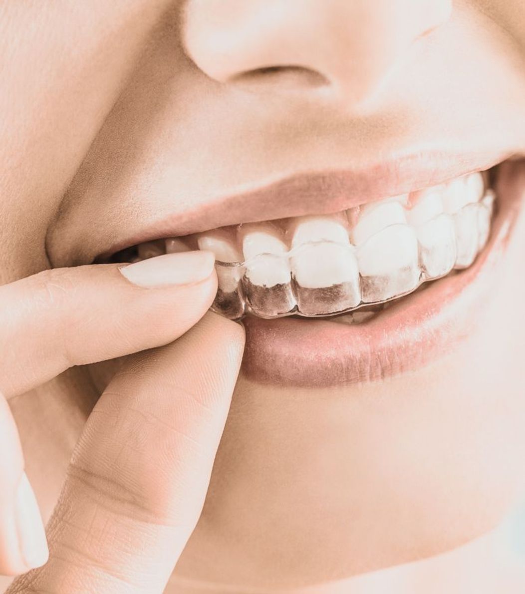 An image of the Invisalign aligners on the teeth.