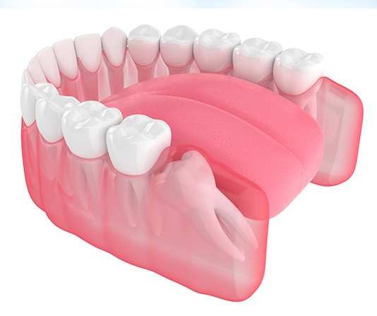 3D redering of wisdom tooth pointing horizontally against back teeth