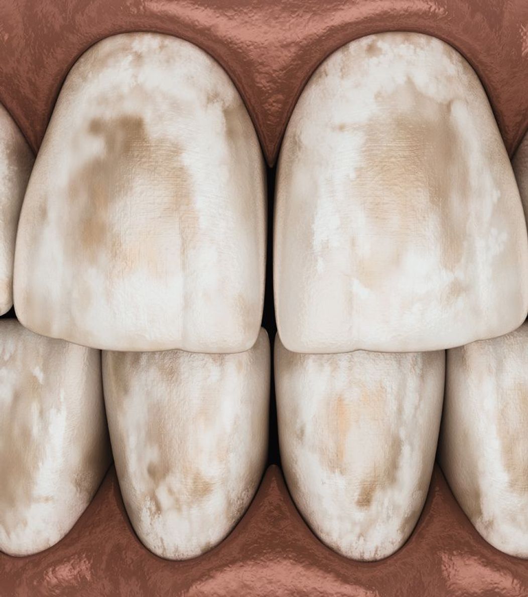 An image of discolored teeth