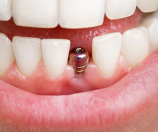 Mouth with dental screw in it