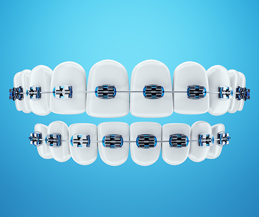 3D model of braces on rows of teeth